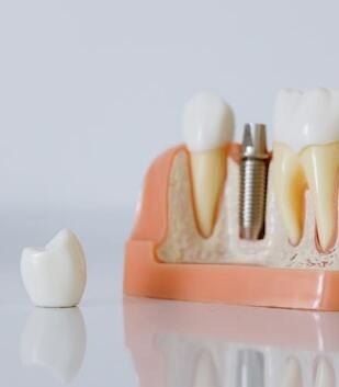 Dental implant showing abutment